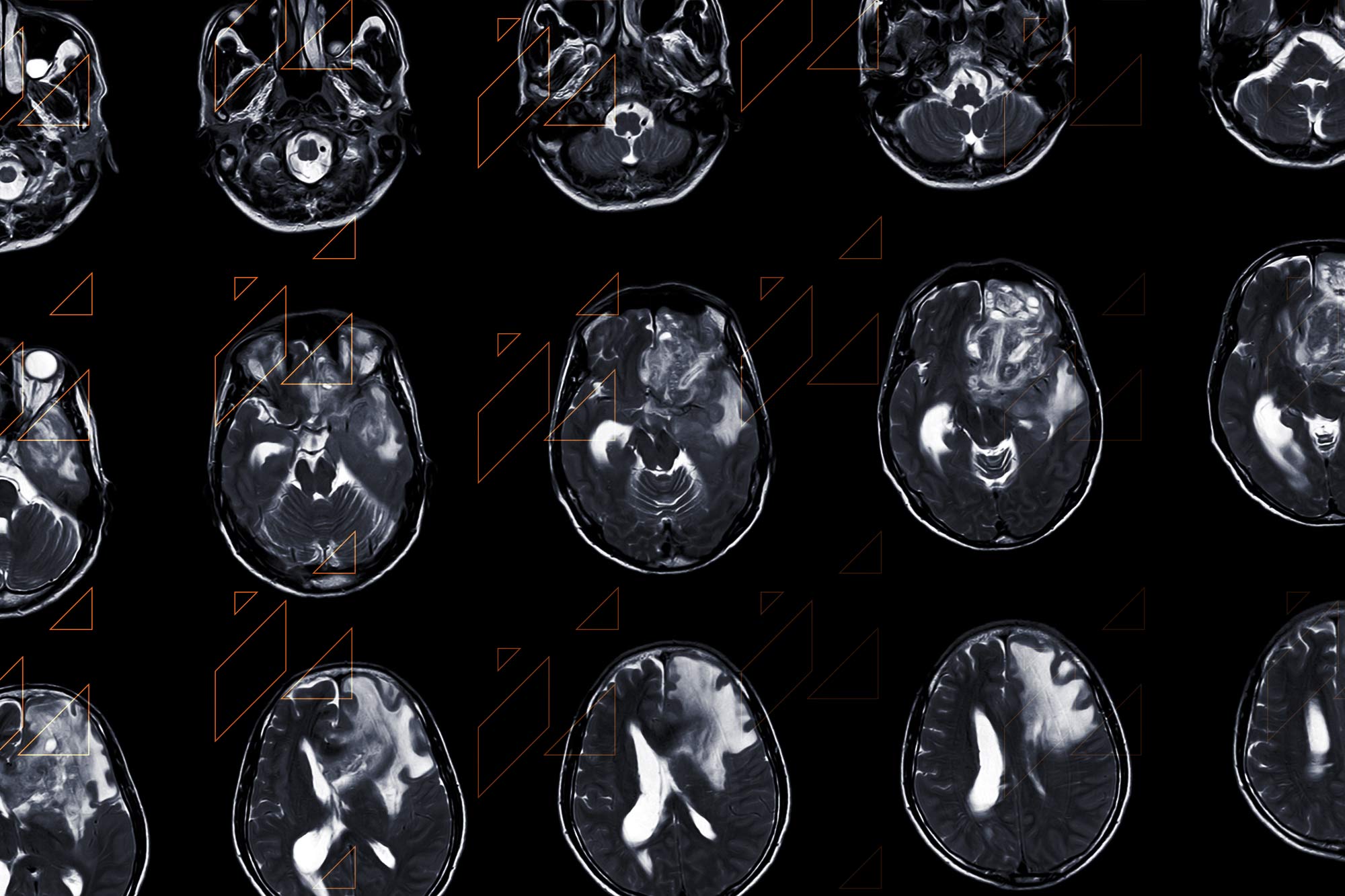 MRI images of a brain with a glioblastoma