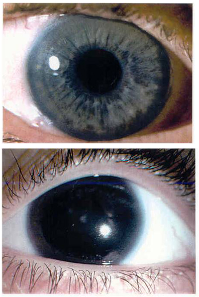 Up close of two peoples eyes.  Top: Normal eye.  Bottom: eye with aniridia