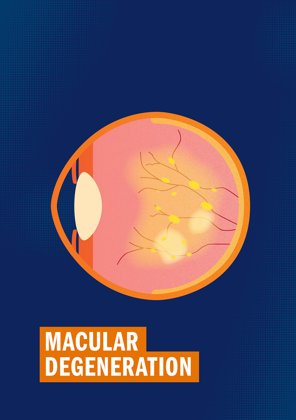 Macular Degeneration