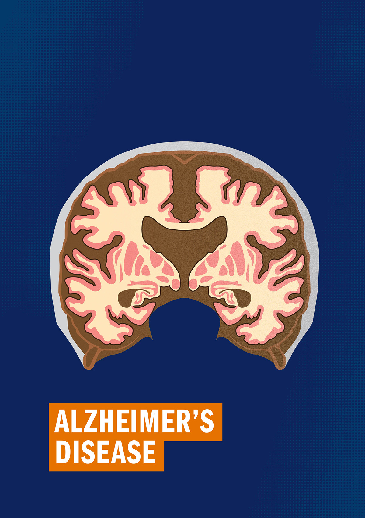 Alzheimer’s Disease