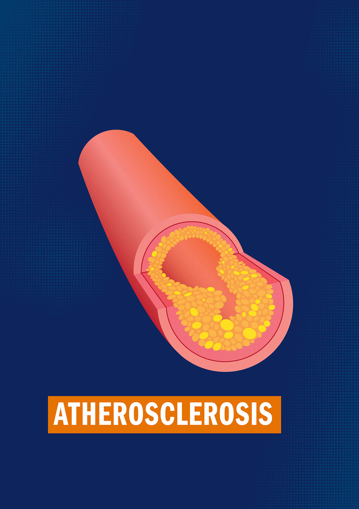 Atherosclerosis