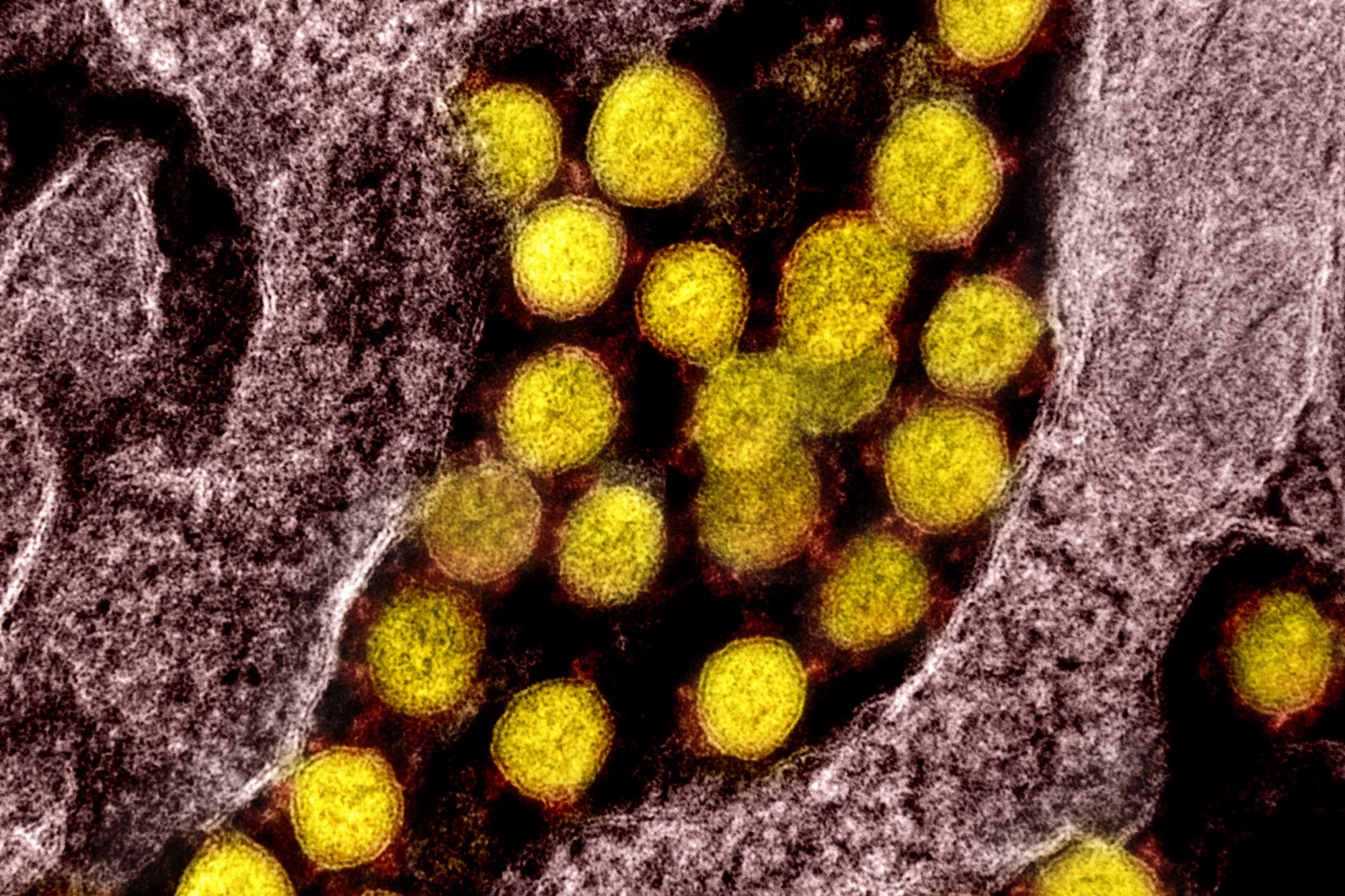 Electron micrograph of SARS-CoV-2