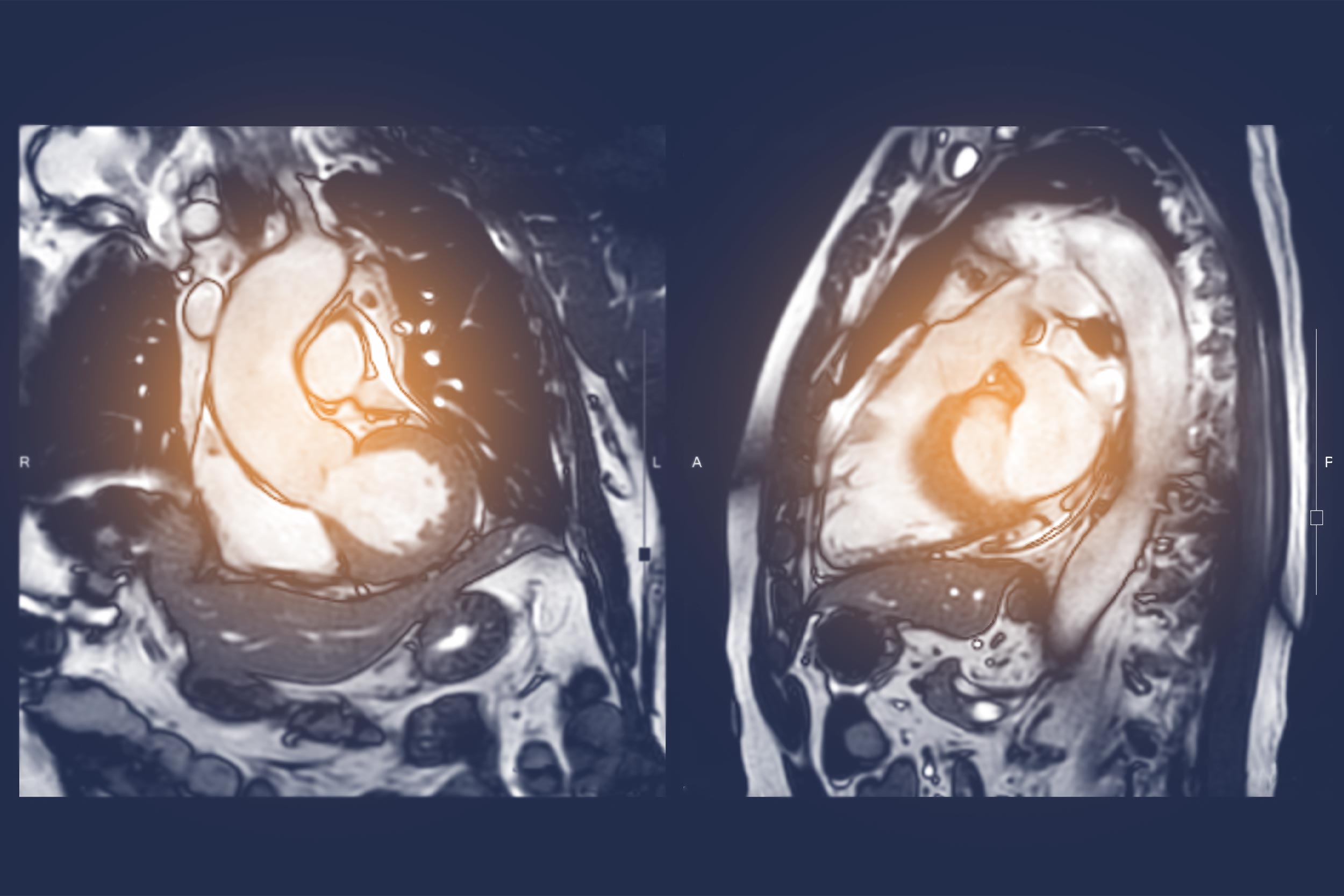 Unlocking Secrets of the Heart: Simple Scan Could Identify Patients at Risk