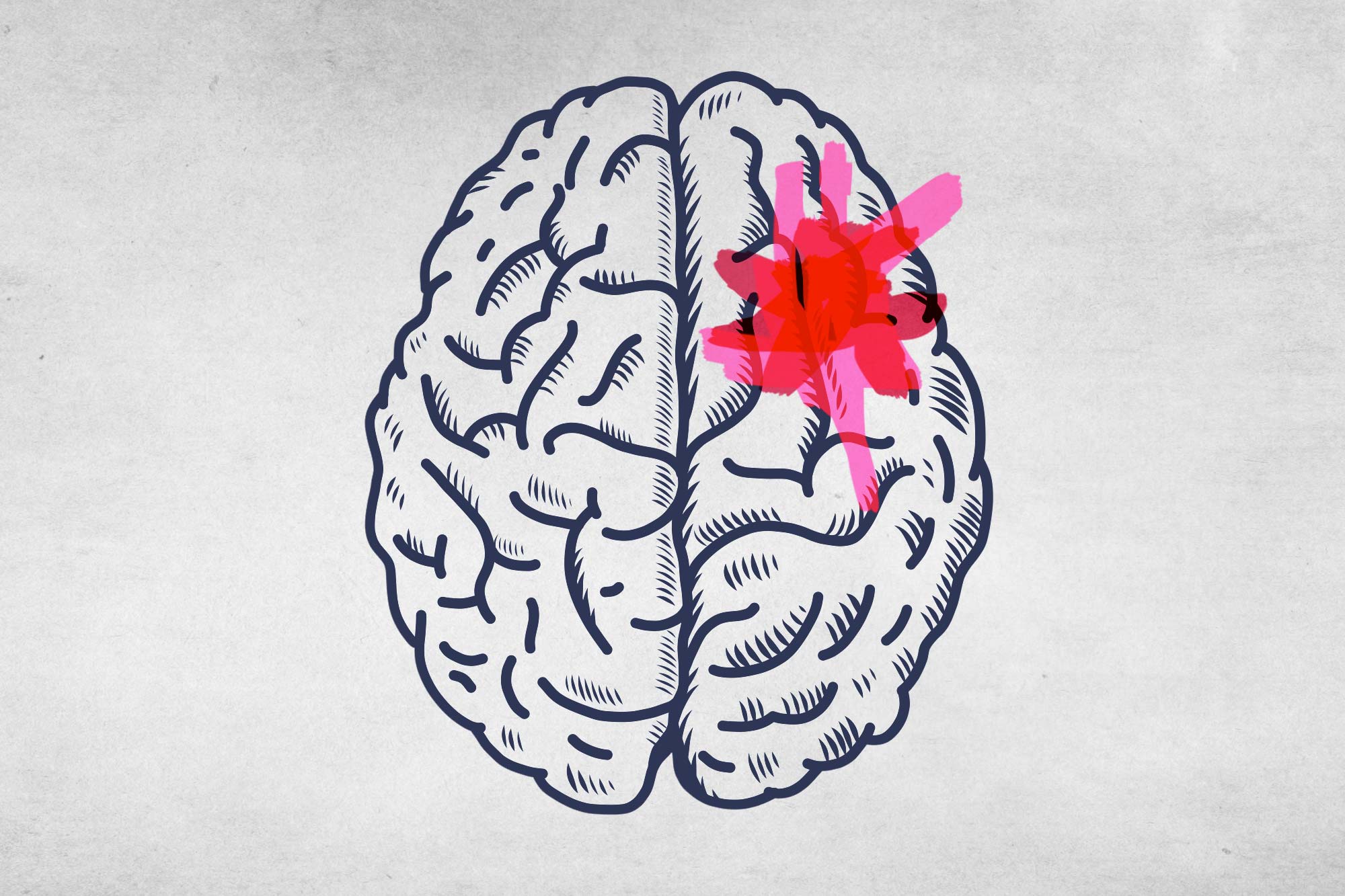 A line drawing of a human brain, with a large pink splotch in the upper right quadrant
