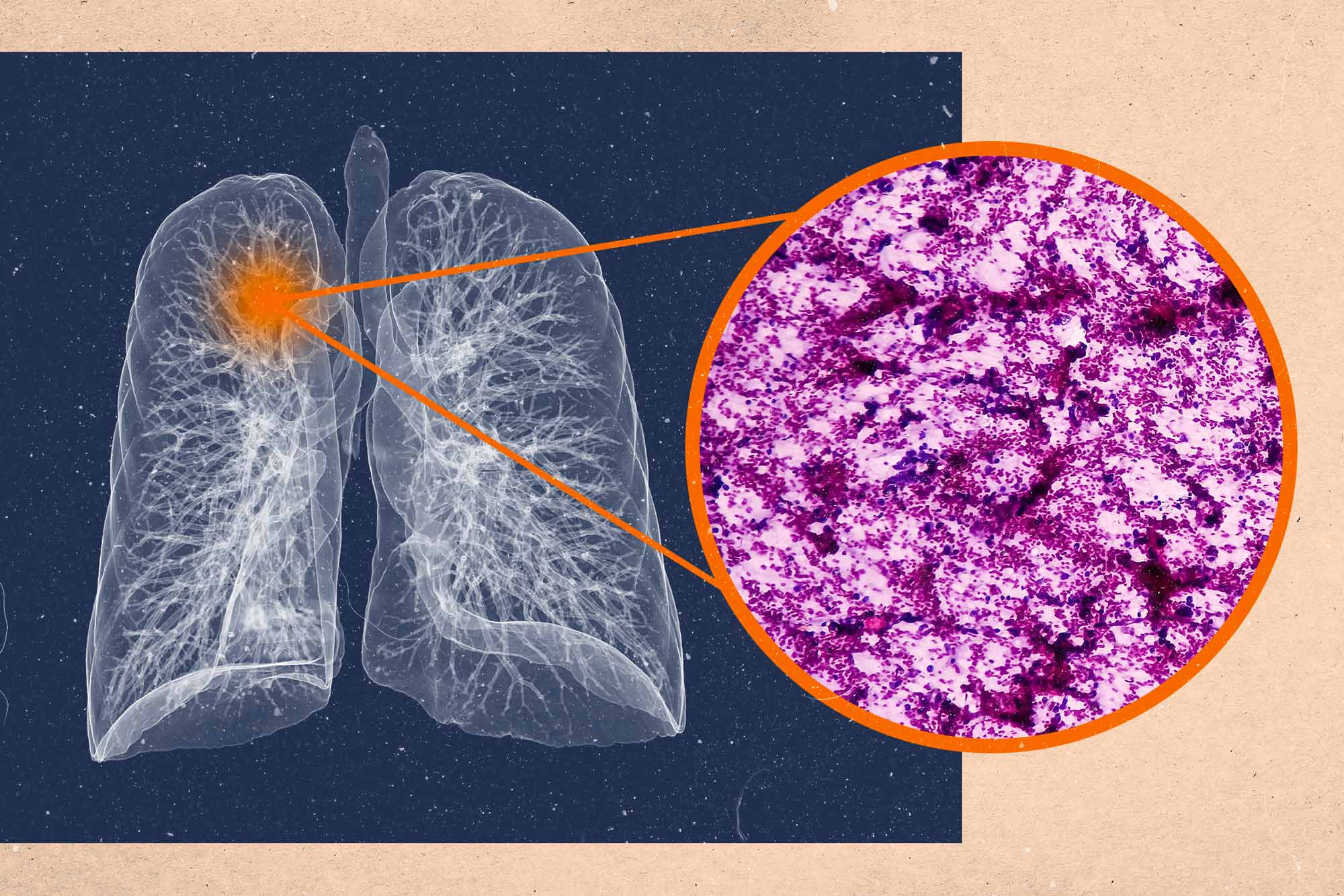 A graphic illustration of lungs with a zoomed in look at a cancer cell