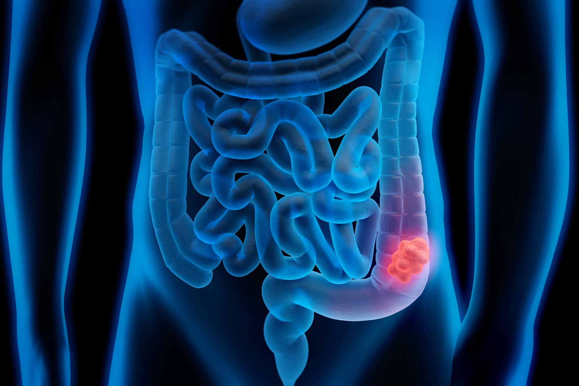 Strange Colon Discovery Explains Racial Disparities In Colorectal