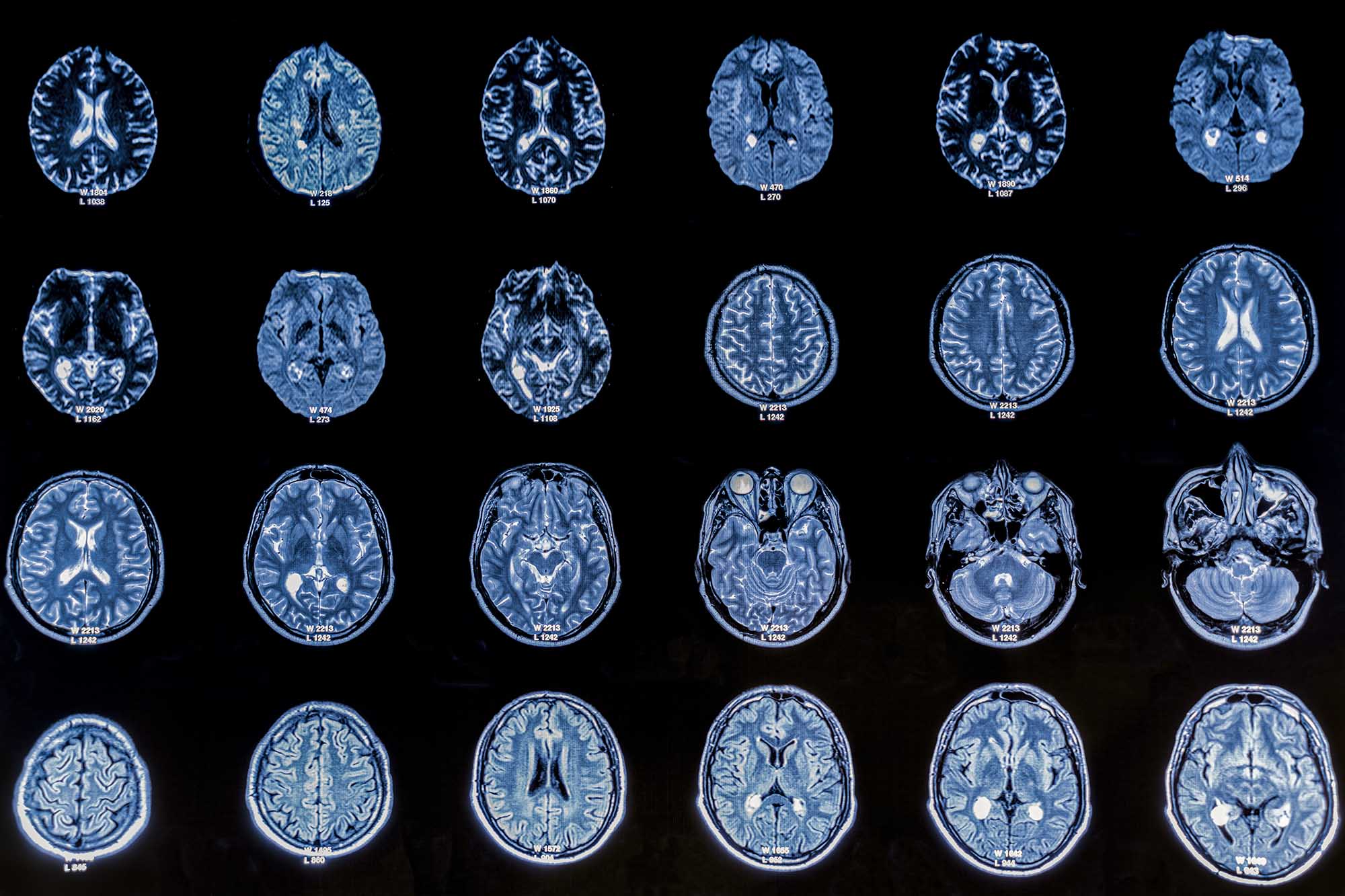 MRI scan of a brain