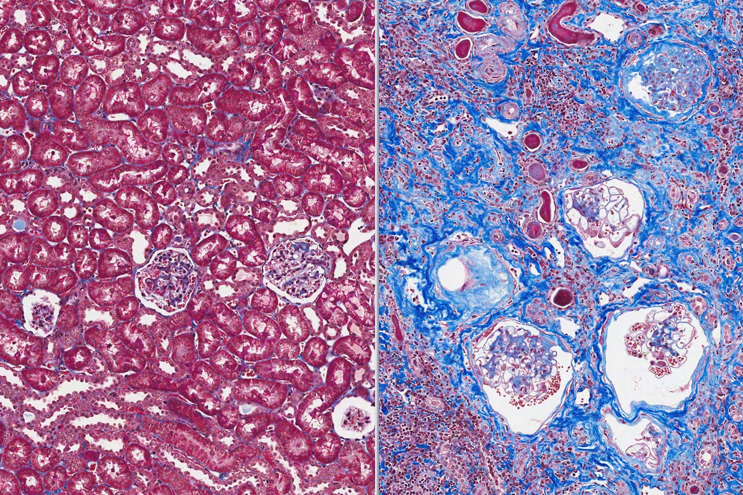 left: pink Fibrosis under a microscope. Right: pink and blue fibrosis under a microscope
