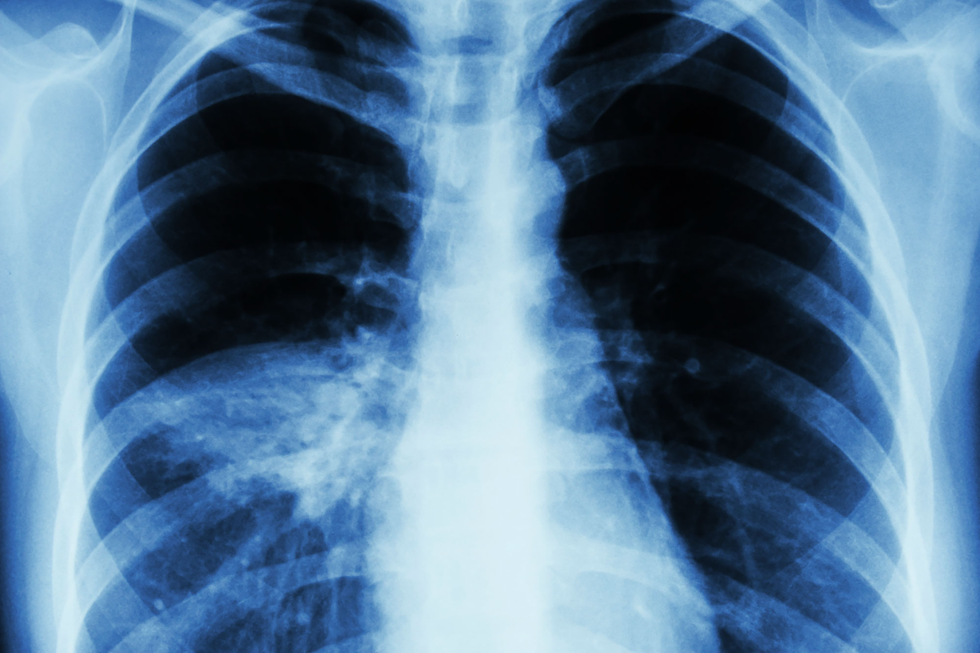 Xray of a persons chest