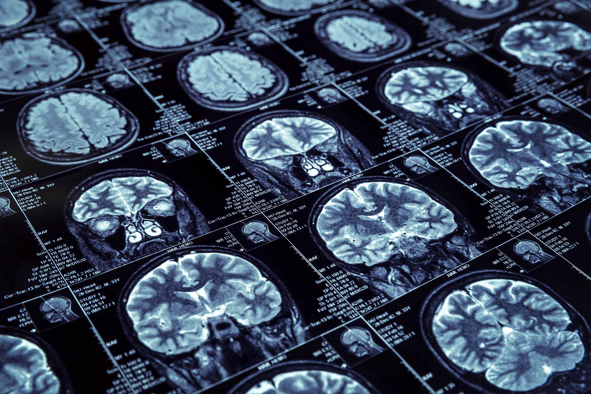 MRI brain scan images