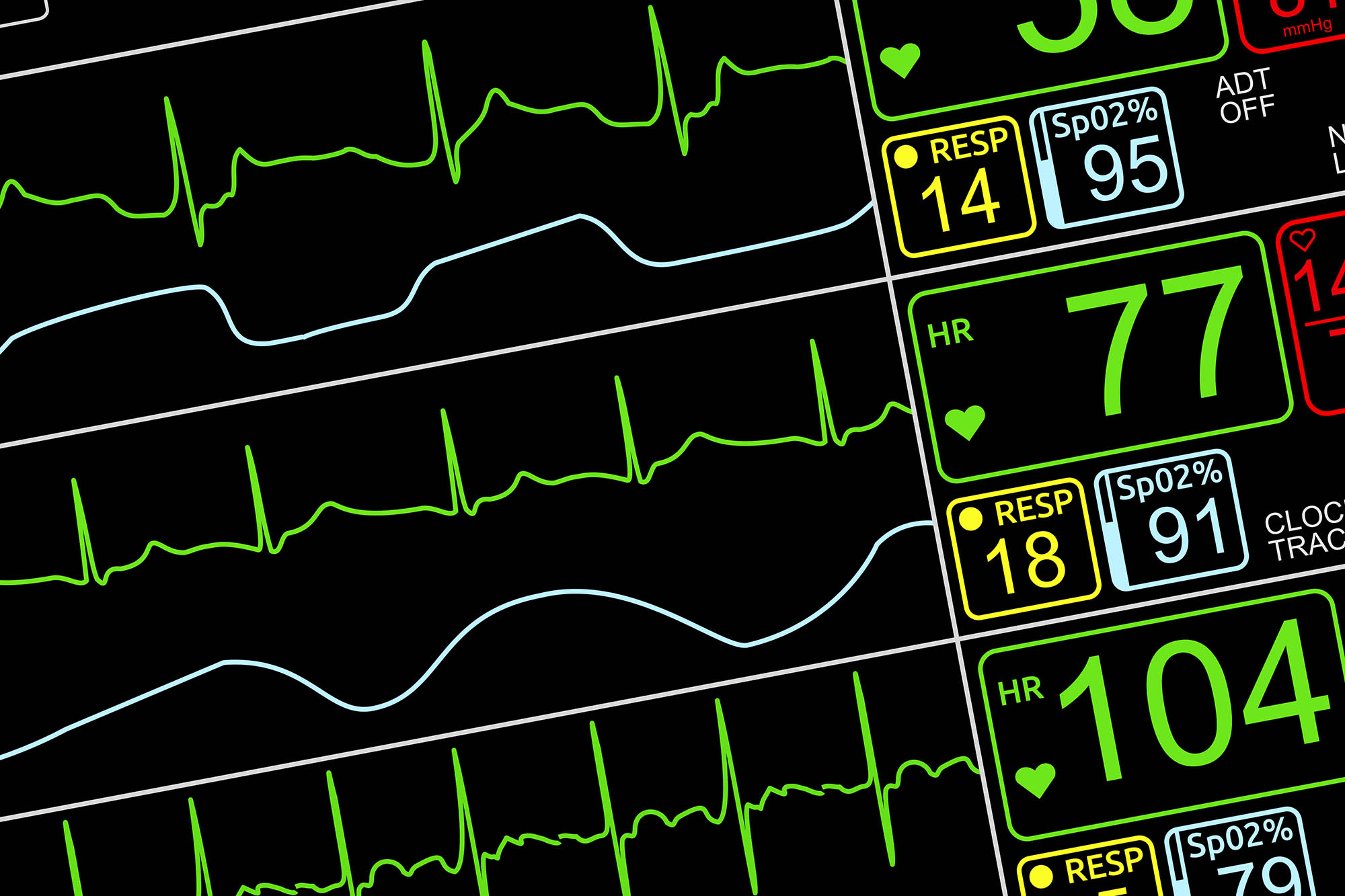 Monitor showing multiple heartbeats and heartrates