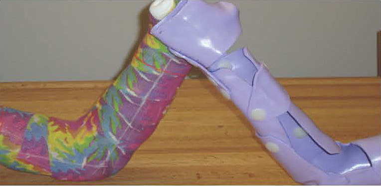 Left: Fiberglass Cast.  Right: Puzzle Cast 