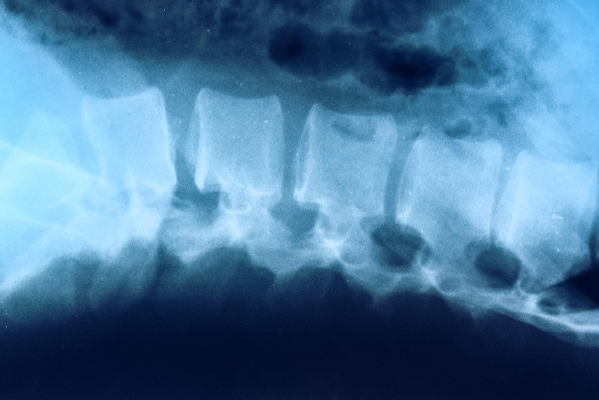 X-ray of vertebrae in a back