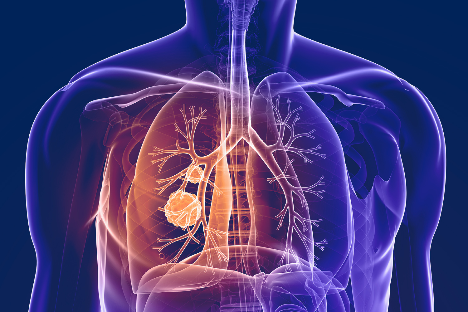 Illustration of Small cell lung cancer