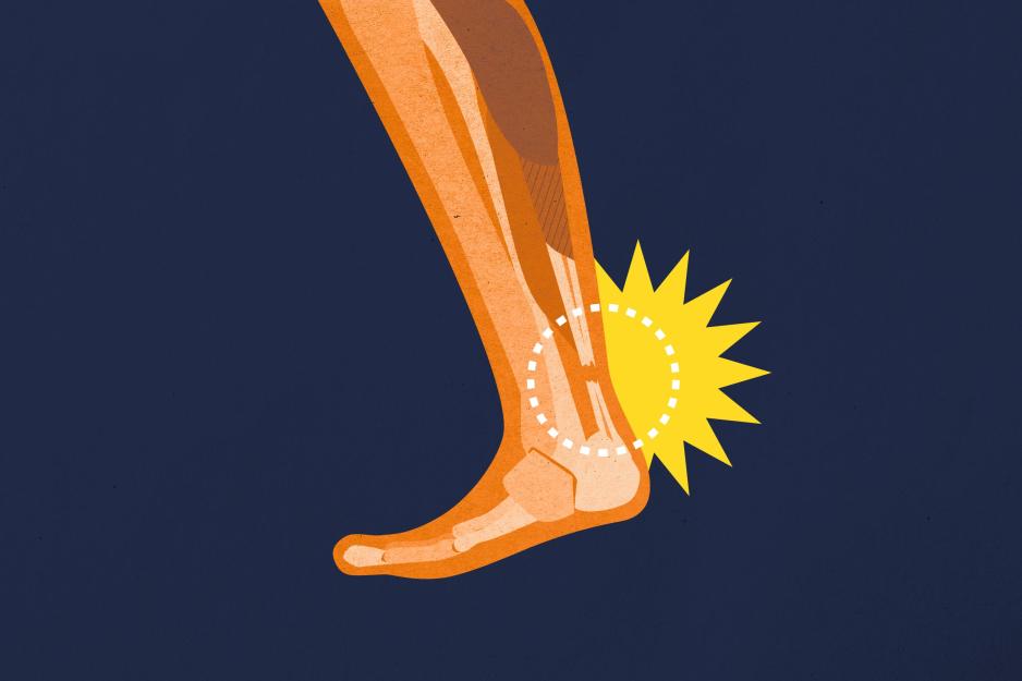 illustration of a torn Achilles tendon