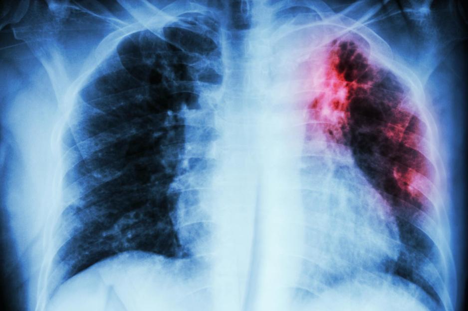 X-ray of a human chest with a large red area in the top of the left lung