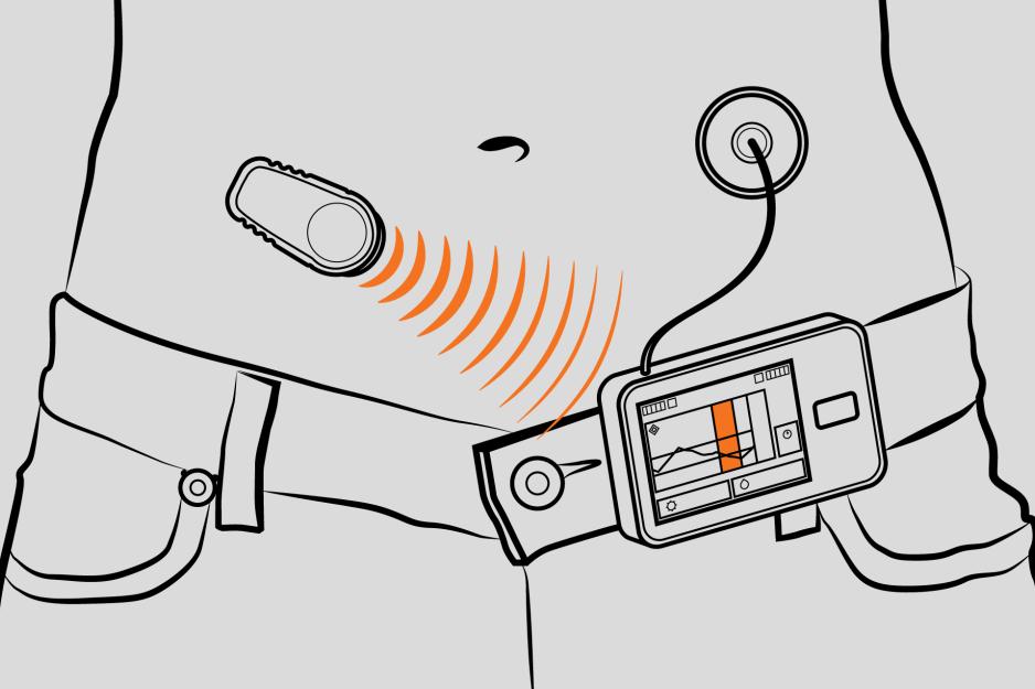 Illustration drawing of a persons waist with a dexcom attached, left, with orange arches going to the right where the dexcom box is attached the persons pants which has a cord going up to a small circle attached to the persons skin