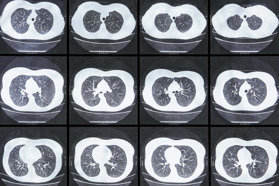 Chest CT scan images