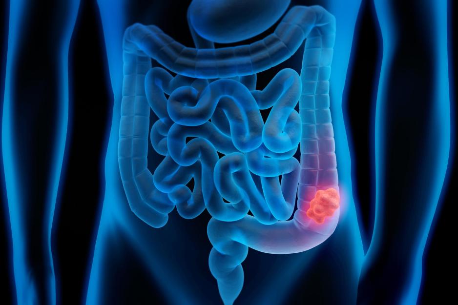 Illustration of the human body with a piece of the human intestine blocked by a red matter