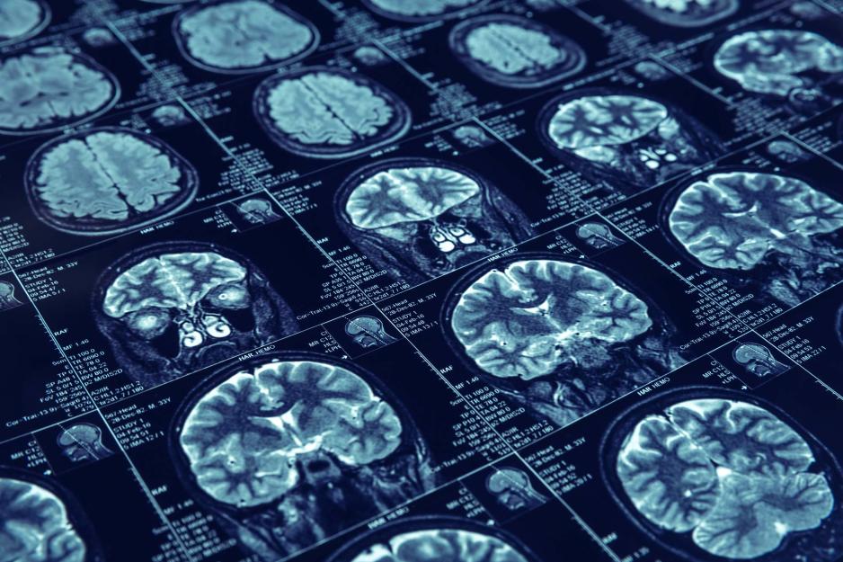 MRI Images of a brain