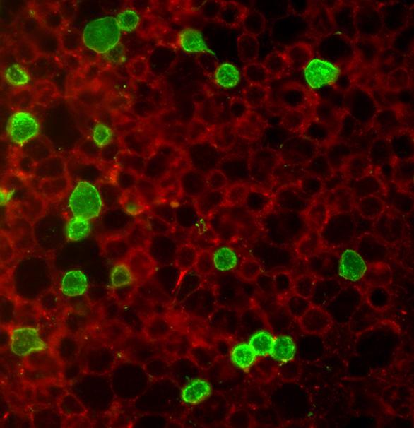 Renin progenitors in the bone marrow with a lymphocyte pedigree (Brenin cells, shown in green) give rise to B-cell leukemia when the Notch pathway effector RBP-J is deleted.