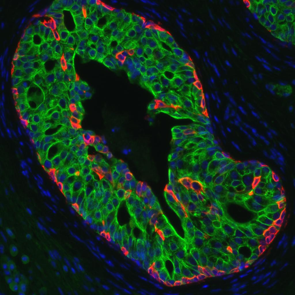  Prostate cancer in a mouse.